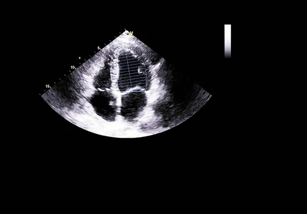 Screen of echocardiography (ultrasound) machine. — Stock Photo, Image