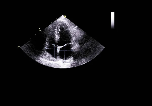 Screen of echocardiography (ultrasound) machine. — Stock Photo, Image