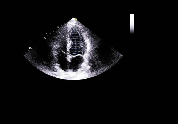 Pantalla de la máquina de ecocardiografía (ultrasonido) . —  Fotos de Stock