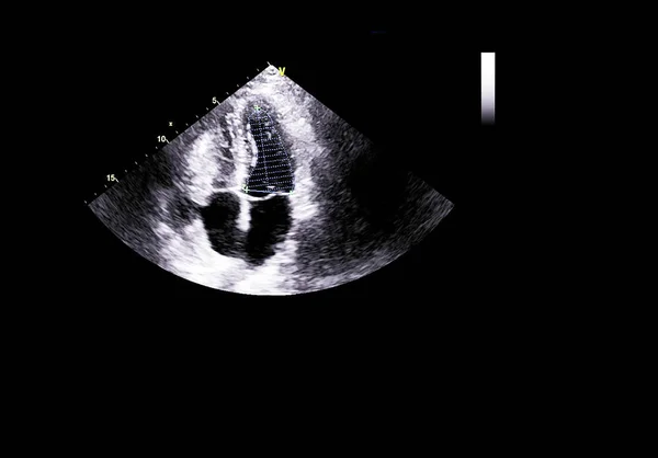 Screen of echocardiography (ultrasound) machine. — Stock Photo, Image