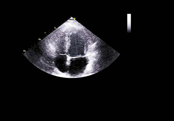 Screen of echocardiography (ultrasound) machine. — Stock Photo, Image