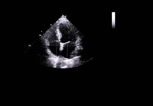 Screen of echocardiography (ultrasound) machine. — Stock Photo, Image