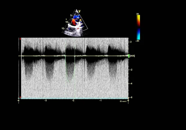 Tela da máquina de ecocardiografia (ultra-som) . — Fotografia de Stock