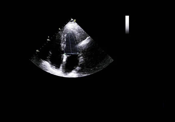 Pantalla de la máquina de ecocardiografía (ultrasonido) . — Foto de Stock