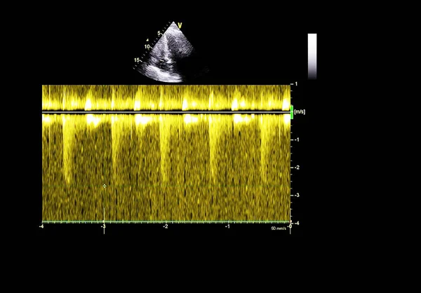 Pantalla de la máquina de ecocardiografía (ultrasonido) . —  Fotos de Stock