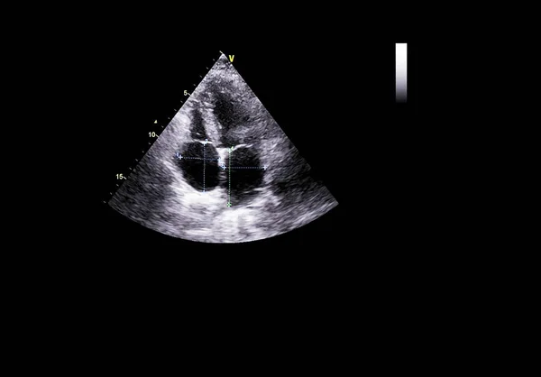 Pantalla de la máquina de ecocardiografía (ultrasonido) . — Foto de Stock