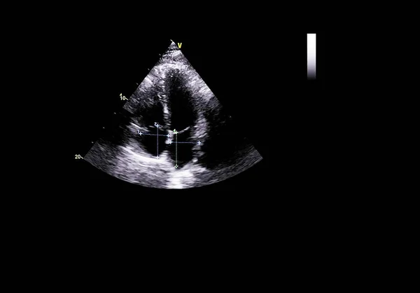 Tela da máquina de ecocardiografia (ultra-som) . — Fotografia de Stock