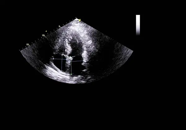 Screen of echocardiography (ultrasound) machine. — Stock Photo, Image