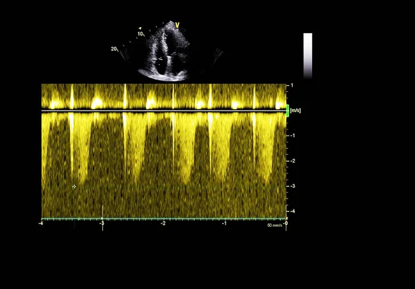 Tela da máquina de ecocardiografia (ultra-som) . — Fotografia de Stock