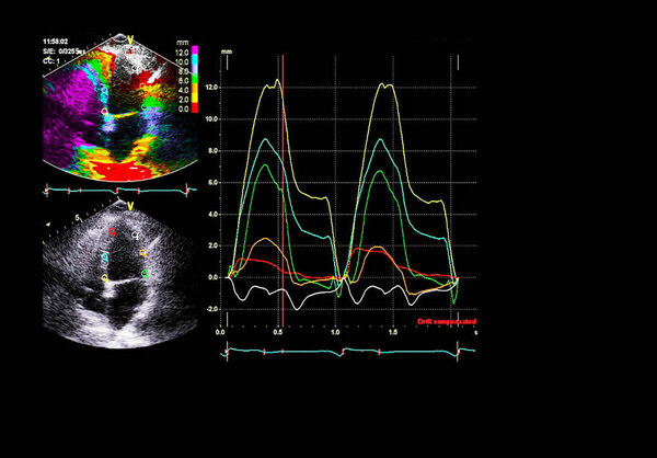 Экран эхокардиографической (ультразвуковой) машины
.