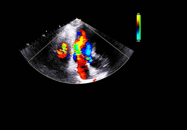 Screen of echocardiography (ultrasound) machine.