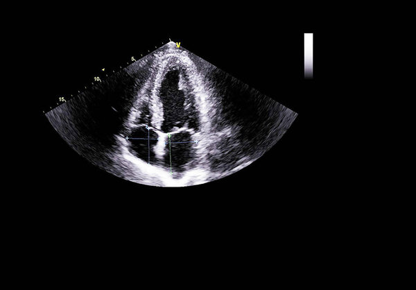 Экран эхокардиографической (ультразвуковой) машины
.