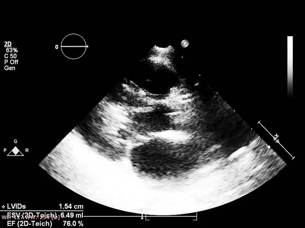 Obrazovka počítače s echokardiografií (ultrazvukem). — Stock fotografie