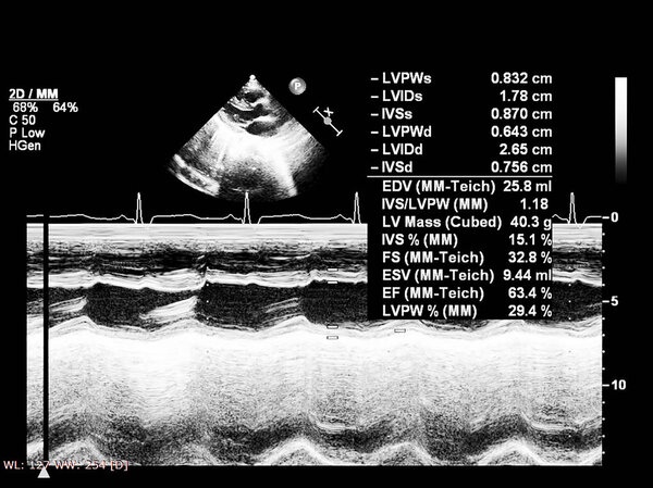 Экран эхокардиографической (ультразвуковой) машины
.