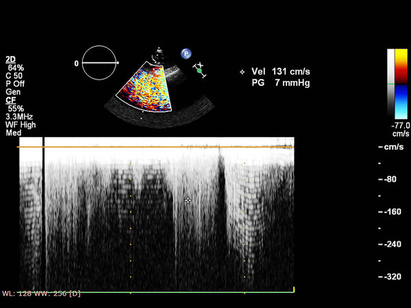 Screen of echocardiography (ultrasound) machine.