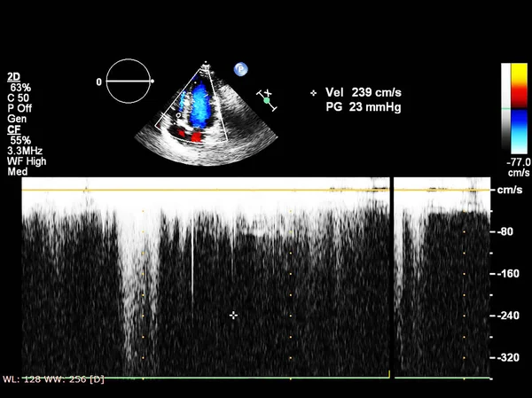 Pantalla de la máquina de ecocardiografía (ultrasonido) . — Foto de Stock