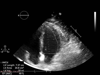 Ekokardiyografi (ultrason) makinesi nin ekranı.