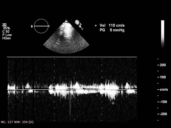 Obrazovka počítače s echokardiografií (ultrazvukem). — Stock fotografie