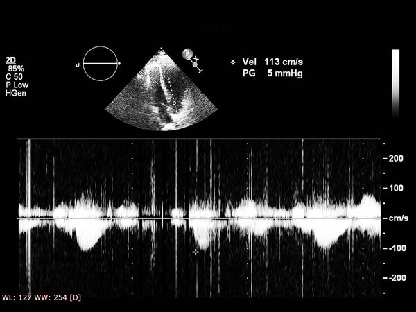 Экран эхокардиографической (ультразвуковой) машины
.