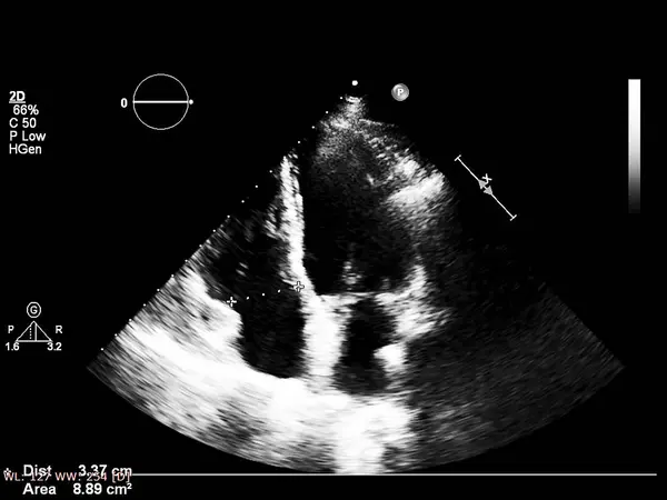 Tela da máquina de ecocardiografia (ultra-som) . — Fotografia de Stock