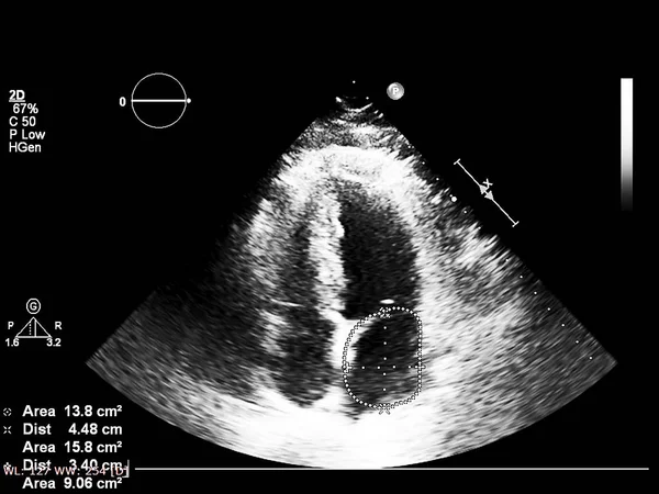 Tela da máquina de ecocardiografia (ultra-som) . — Fotografia de Stock