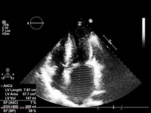 Экран эхокардиографической (ультразвуковой) машины . — стоковое фото