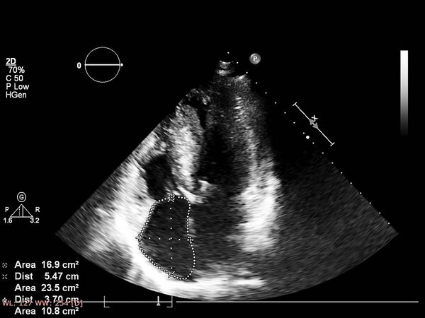 Screen of echocardiography (ultrasound) machine.