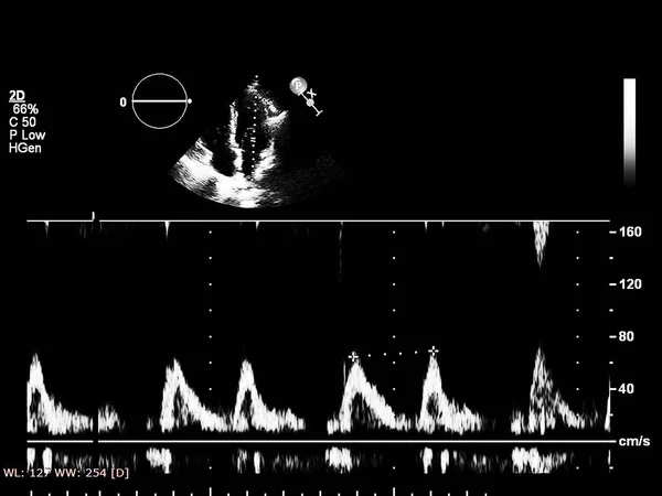 Screen of echocardiography (ultrasound) machine. — Stock Photo, Image