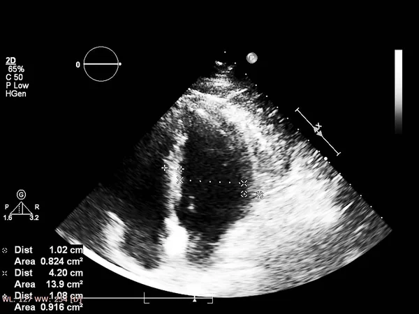 Pantalla de la máquina de ecocardiografía (ultrasonido) . — Foto de Stock