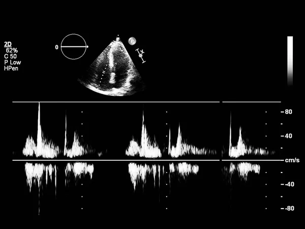 Screen of echocardiography (ultrasound) machine. — Stock Photo, Image