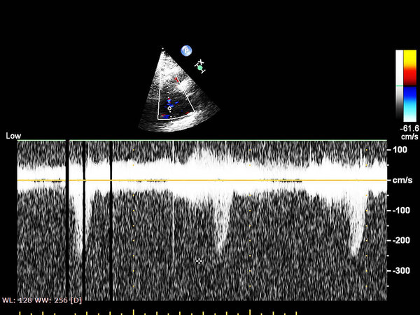 Экран эхокардиографической (ультразвуковой) машины
.