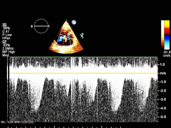 Tela da máquina de ecocardiografia (ultra-som) . — Fotografia de Stock
