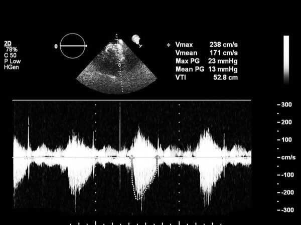 Экран эхокардиографической (ультразвуковой) машины
.