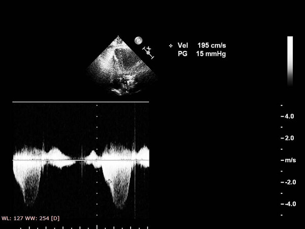 Экран эхокардиографической (ультразвуковой) машины
.