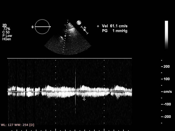 Экран эхокардиографической (ультразвуковой) машины
.