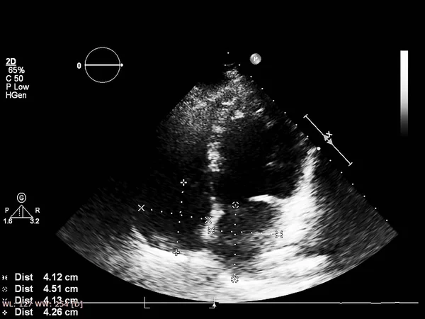 Tela da máquina de ecocardiografia (ultra-som) . — Fotografia de Stock