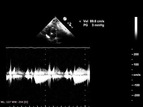 Экран эхокардиографической (ультразвуковой) машины
.