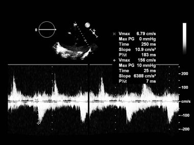 Ekokardiyografi (ultrason) makinesi nin ekranı.