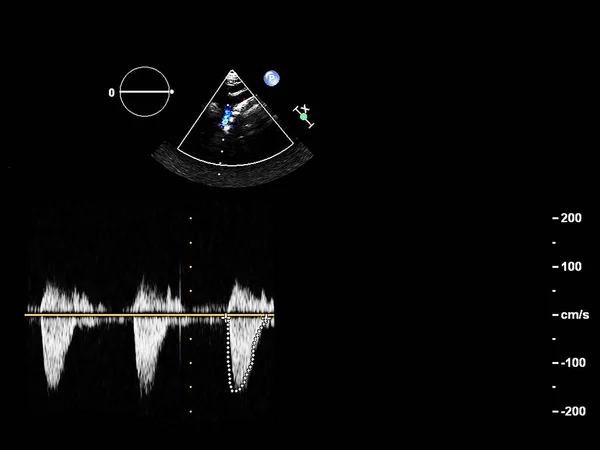 Pantalla de la máquina de ecocardiografía (ultrasonido) . — Foto de Stock