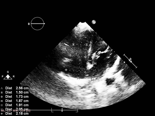Экран эхокардиографической (ультразвуковой) машины
.