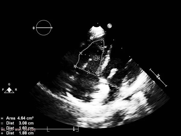 Tela da máquina de ecocardiografia (ultra-som) . — Fotografia de Stock