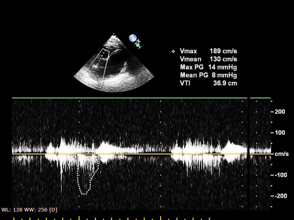 Экран эхокардиографической (ультразвуковой) машины
.