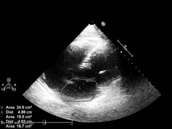 Tela da máquina de ecocardiografia (ultra-som) . — Fotografia de Stock