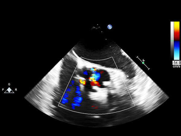 Экран эхокардиографической (ультразвуковой) машины
.