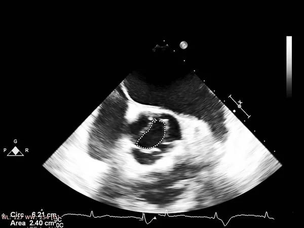 Screen of echocardiography (ultrasound) machine. — Stock Photo, Image