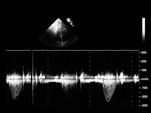 Tela da máquina de ecocardiografia (ultra-som) . — Fotografia de Stock