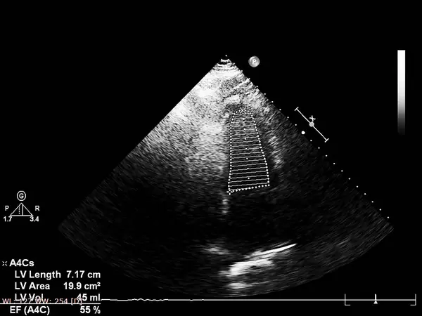 Pantalla de la máquina de ecocardiografía (ultrasonido) . — Foto de Stock