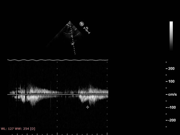 Экран эхокардиографической (ультразвуковой) машины
.