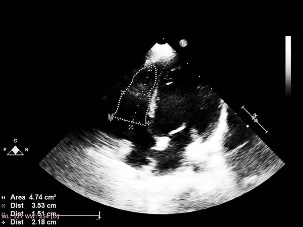 Tela da máquina de ecocardiografia (ultra-som) . — Fotografia de Stock