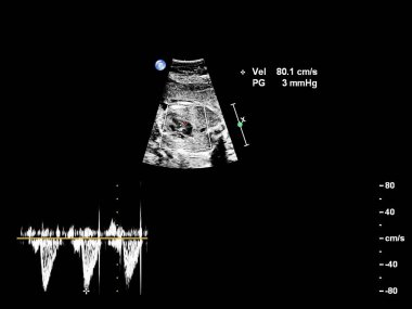 Fetal ekokardiyografi ile ultrasonografi ekranı.